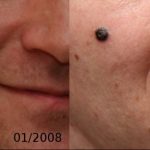 Melanoma - Cancro della pelle
